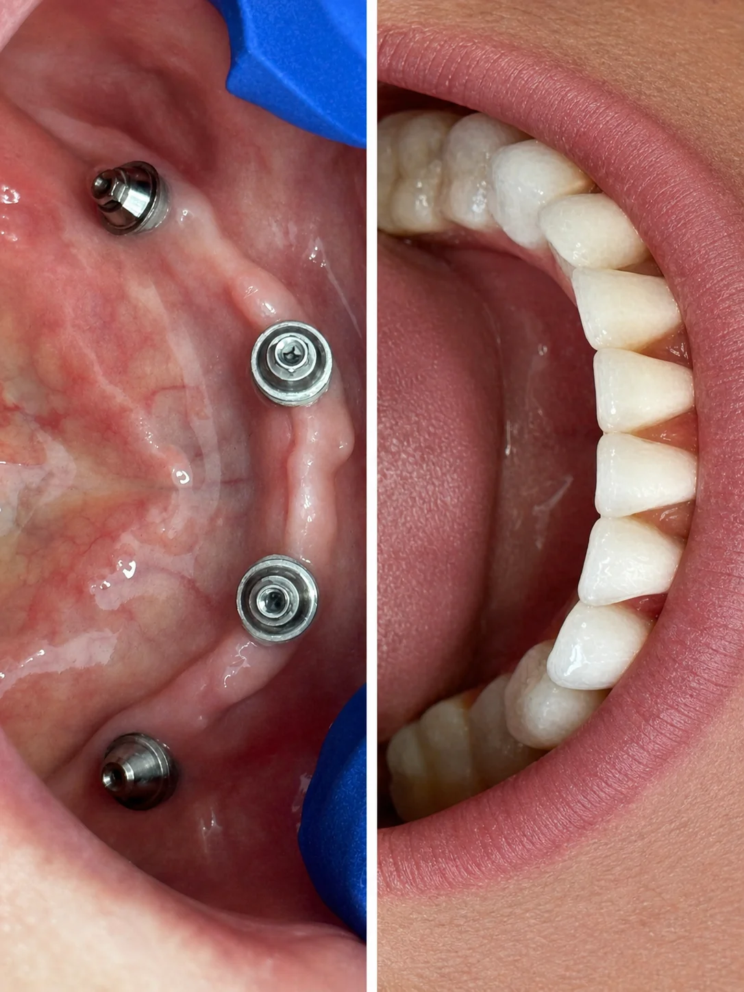 Antes e depois de implantes dentários
