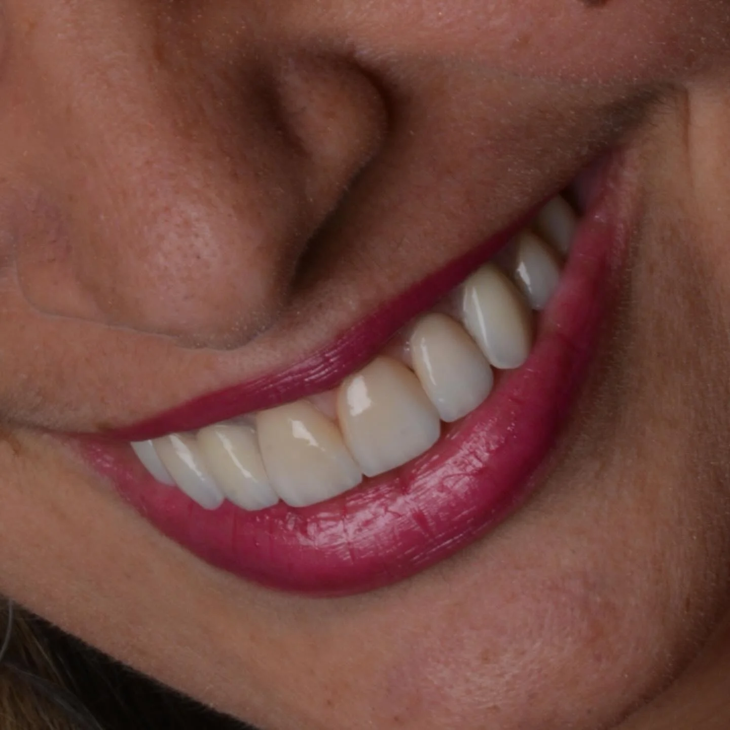 Resultado de lentes de contato dental